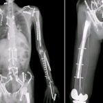 travis-pastrana-goes-viral-with-a-body-full-of-bolts,-the-true-story-of-the-extreme-athlete-nicknamed-iron-man