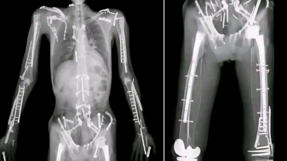 travis-pastrana-goes-viral-with-a-body-full-of-bolts,-the-true-story-of-the-extreme-athlete-nicknamed-iron-man