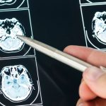 commemorating-world-brain-tumor-day-on-june-8,-increase-public-education-about-this-dangerous-disease