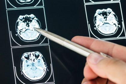 commemorating-world-brain-tumor-day-on-june-8,-increase-public-education-about-this-dangerous-disease