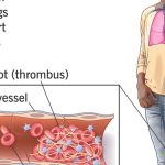 world-antiphospholipid-antibody-syndrome-day-june-9,-know-the-facts-about-this-disease-and-warnings