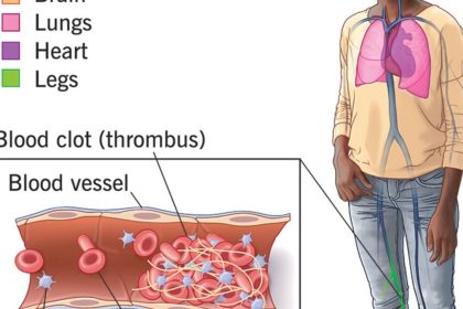 world-antiphospholipid-antibody-syndrome-day-june-9,-know-the-facts-about-this-disease-and-warnings