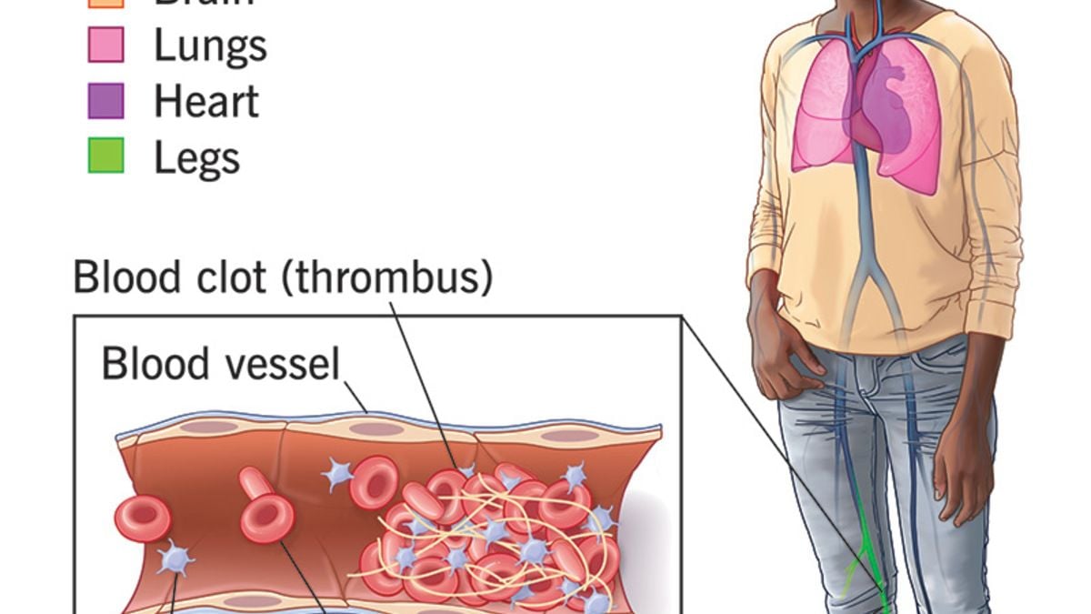 world-antiphospholipid-antibody-syndrome-day-june-9,-know-the-facts-about-this-disease-and-warnings