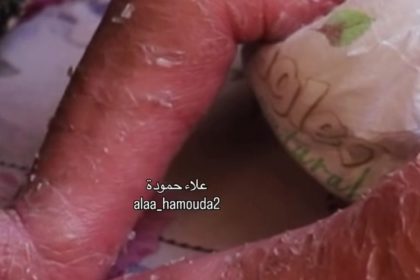 this-three-month-old-baby-in-palestine-has-a-rare-skin-condition-and-needs-treatment-abroad