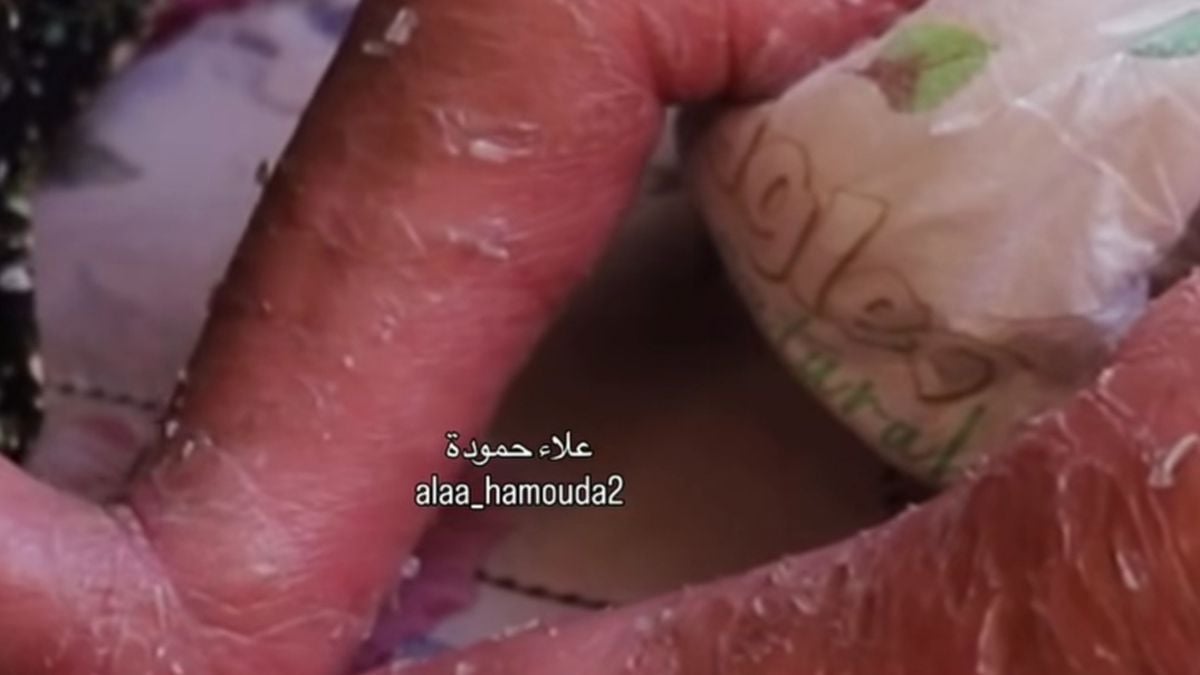 this-three-month-old-baby-in-palestine-has-a-rare-skin-condition-and-needs-treatment-abroad