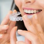 Clear Aligner